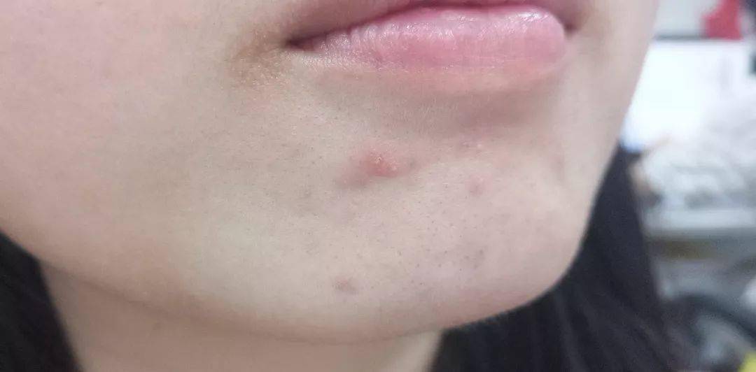 灭火器|1滴让你爱上!从满脸爆痘到光滑无瑕,我只用了这瓶火爆ins的“痘痘灭火器”!