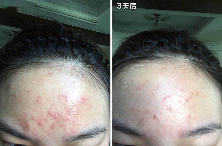 灭火器|1滴让你爱上!从满脸爆痘到光滑无瑕,我只用了这瓶火爆ins的“痘痘灭火器”!