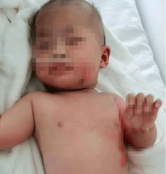 孩子|家属这样处理,差点让小孩送命......心疼~福建6月大女婴被开水烫伤