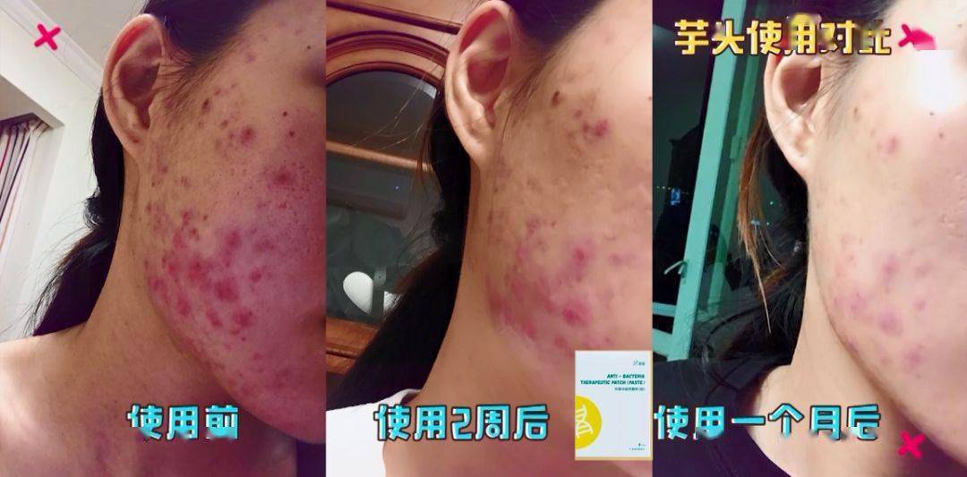 救星|这款PS级的“烂脸救星”，让我抛弃了SKII的“前男友面膜”！