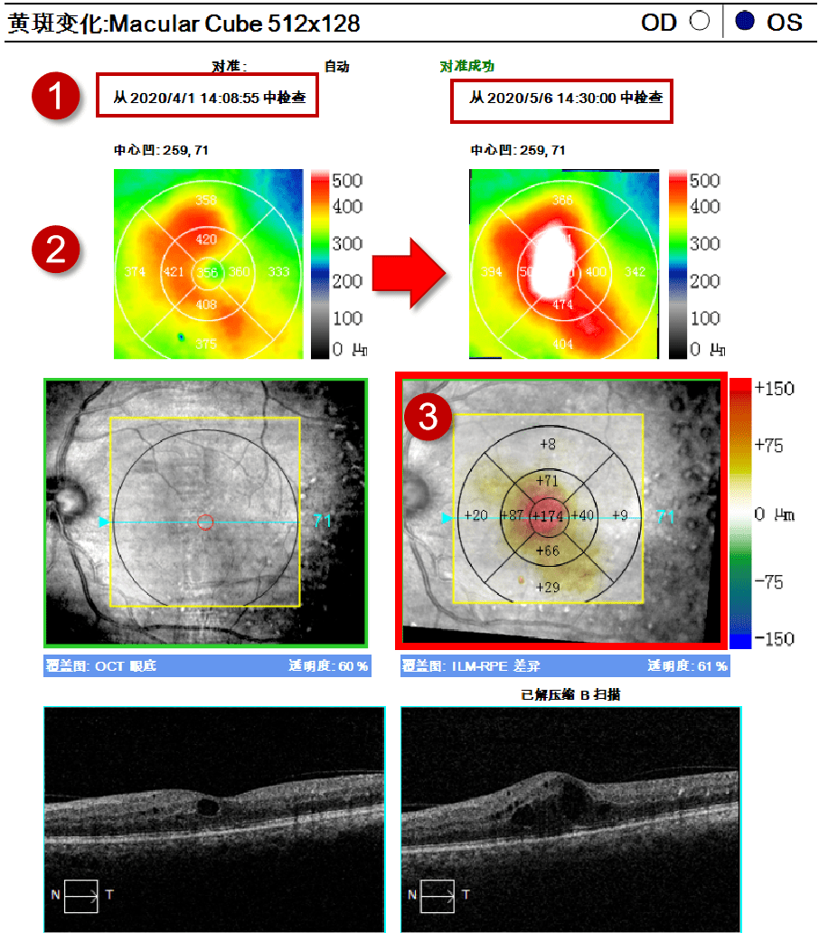 由于血糖控制不好,黄斑区水肿高度增加; 1,显示前后两次扫描时间 2