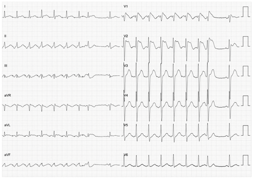 患者|这个房颤患者，让医生直呼“太惨了”……
