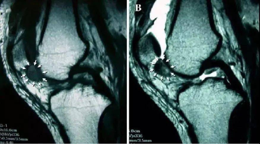 髌下脂肪囊及关节腔滑膜呈绒毛,结节样隆起,并可见形态不规则t1,t2双