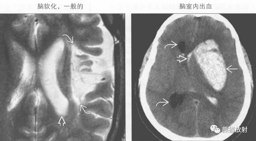 胎儿脑室不对称怎么办