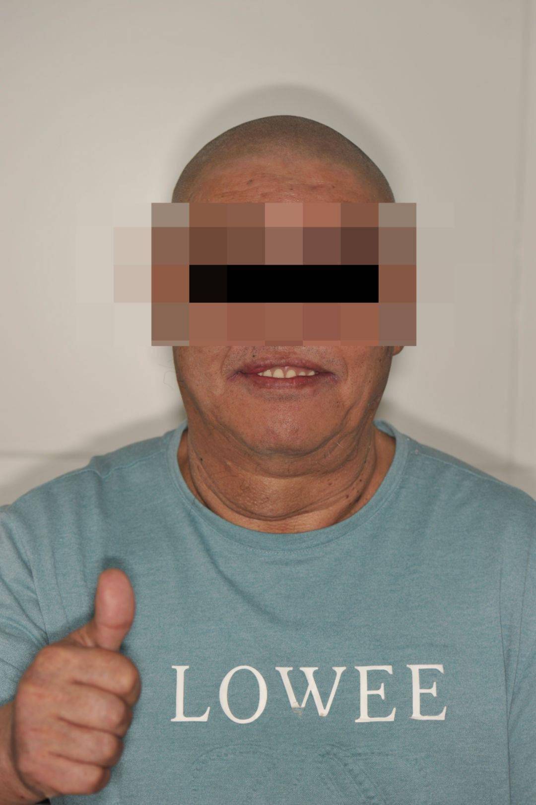 口腔科门诊完成一例单侧颌骨完全缺失复杂种植修复病例