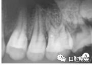 上颌阻生第三磨牙导致第一磨牙远颊根吸收1例