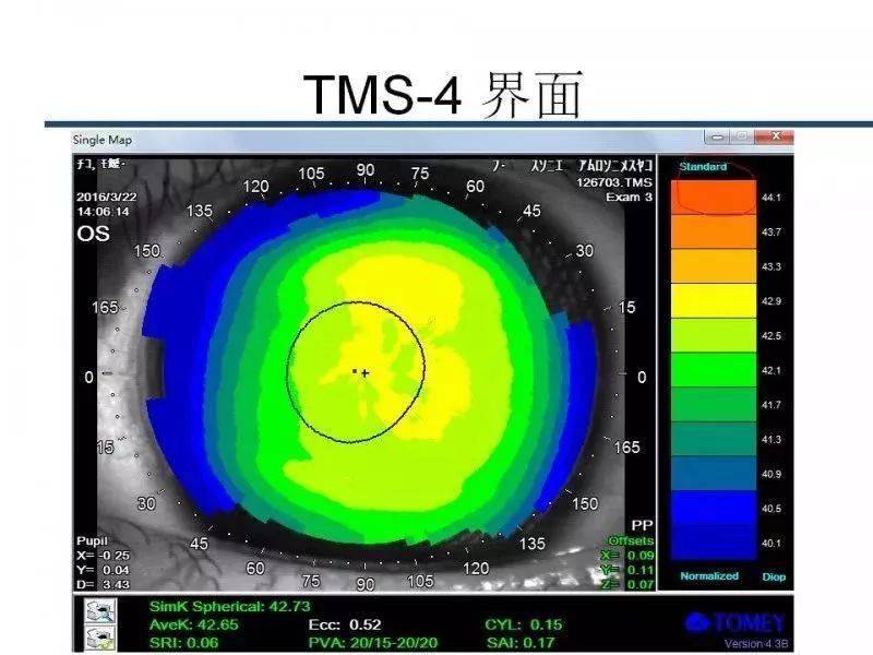 【眼视光】 角膜地形图阅读及基本使用