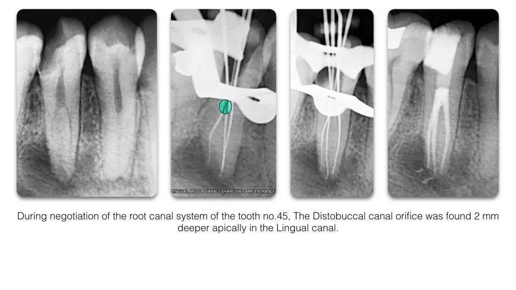 【牙医学堂】下颌前磨牙:多样化的根管解剖