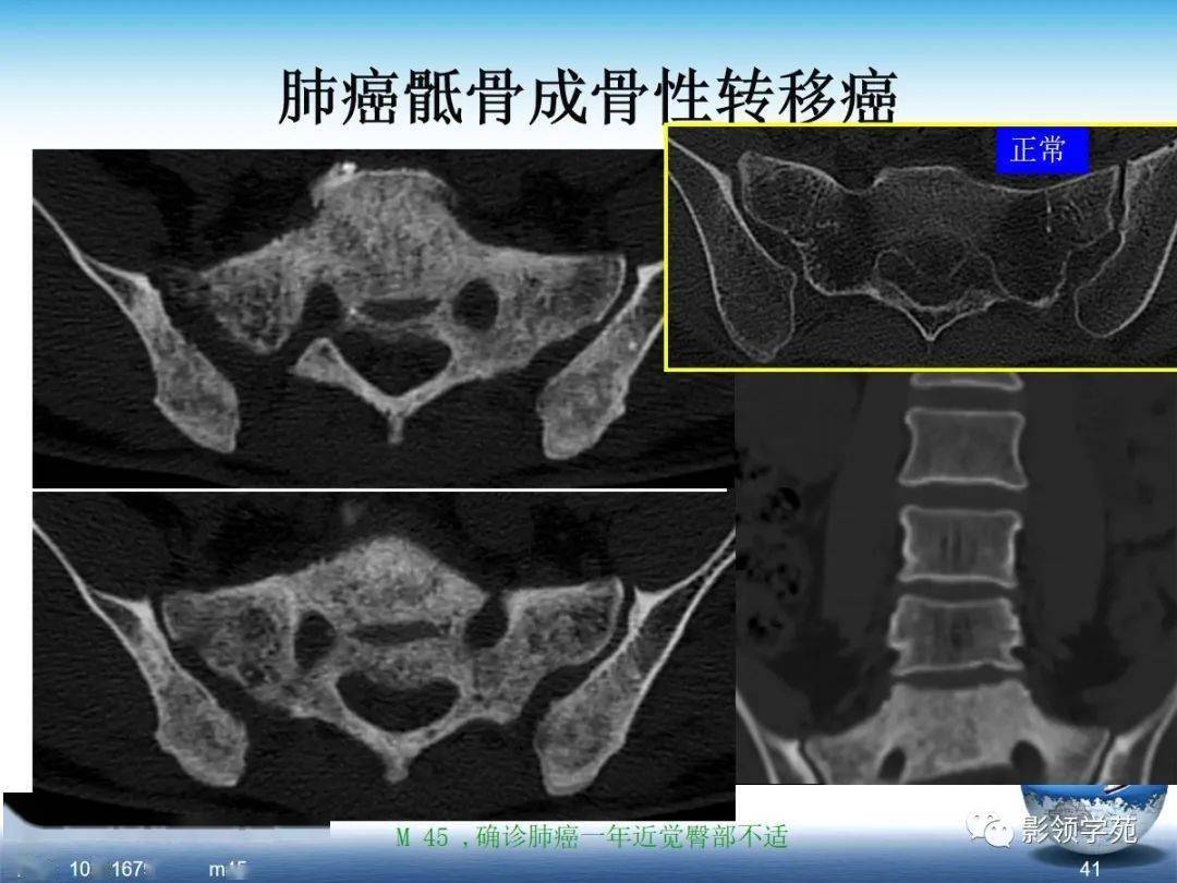 spa骶髂关节炎的影像学诊断与鉴别