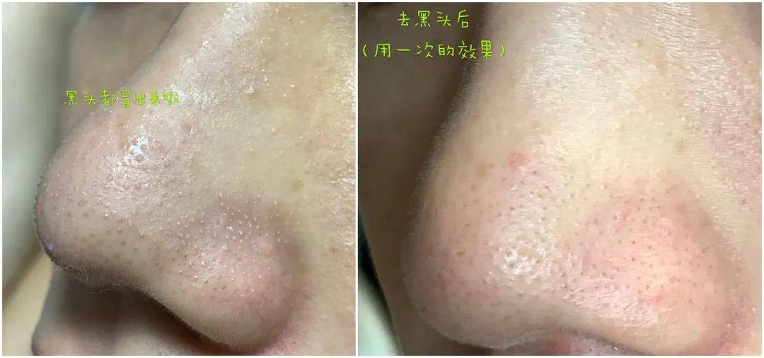 黑头|【七夕送给亲爱的她】看到包装就已经沦陷了！黑头遇到劲敌啦！