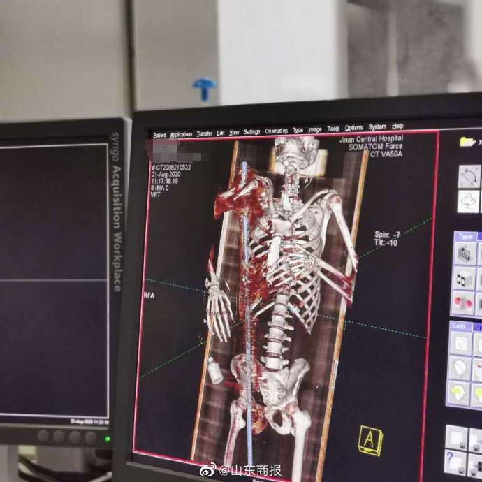 患者|险！1米长钢筋贯穿男子体内