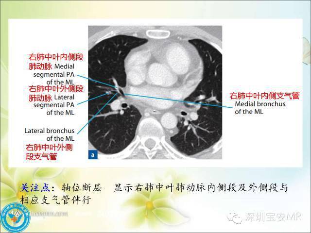 解剖心脏大血管丨肺动脉和肺静脉影像断层解剖