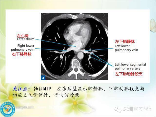 解剖心脏大血管丨肺动脉和肺静脉影像断层解剖