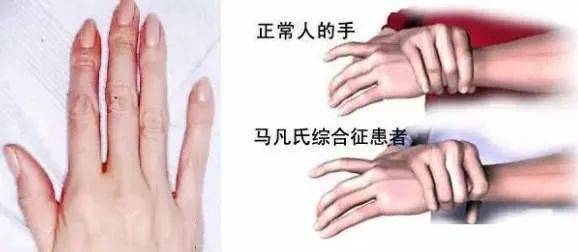 患者|一家三人都是高个子、大长腿，竟然是这种可怕的遗传病！