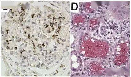 综合征|不一样的肺出血肾炎综合征