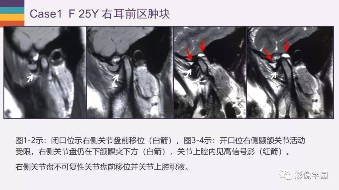 颞颌关节病变的mri诊断