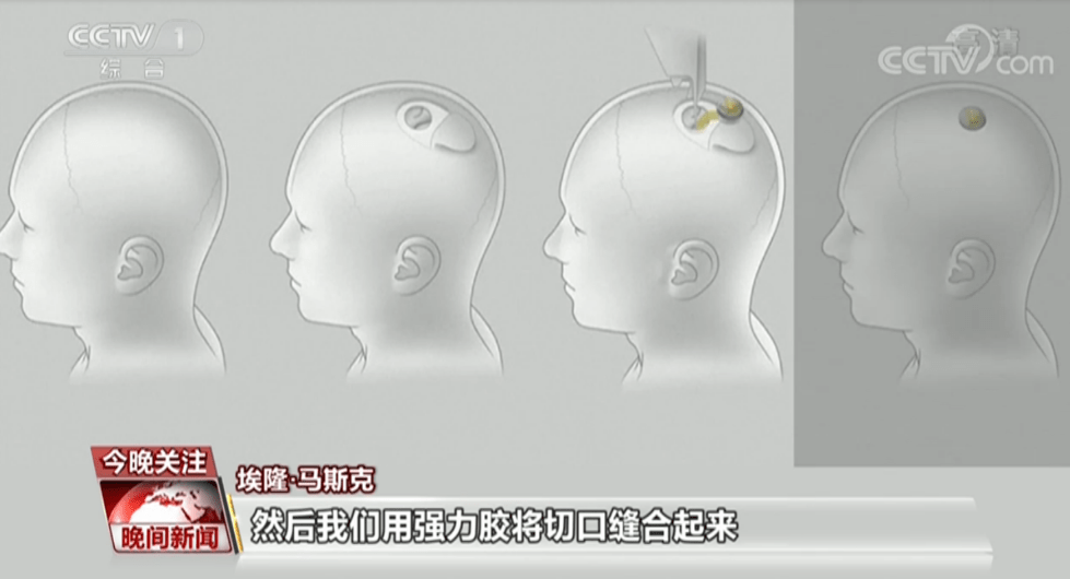 马斯克|头皮发麻！马斯克带小猪演示脑机接口新成果 为何必须“侵入”大脑？