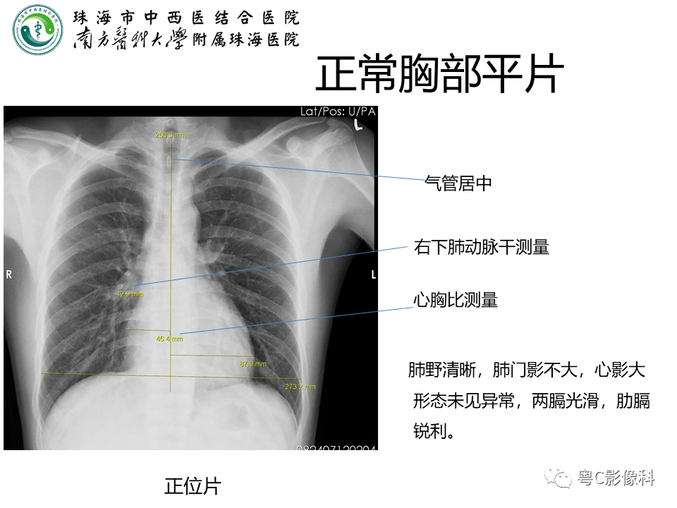 胸部影像 | 胸部x线解剖,摄影,常见疾病表现