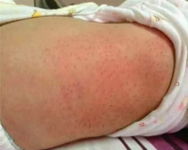 毒刺|得知原因后妈妈气坏了！宝宝身上长满黑色“毒刺”