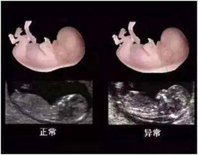 筛查|唐筛这道“安检门”你过了吗？不想生“唐宝宝”