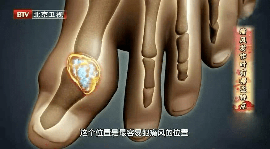 痛风|人体最痛的六种病,痛风仅排第五!希望你一个都没经历过~