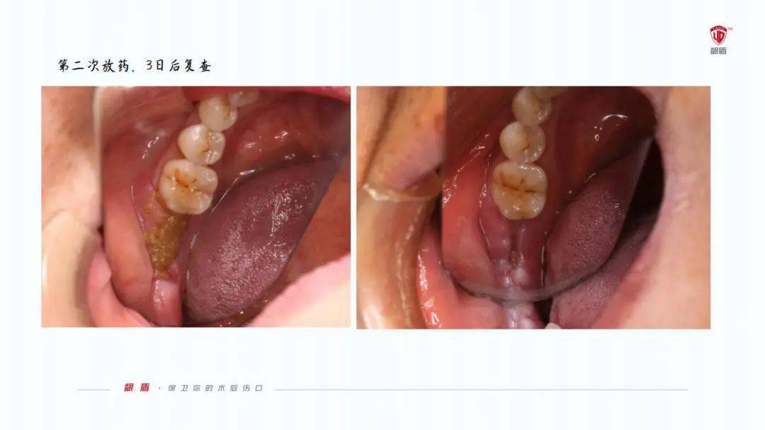 吃什么能使牙龈上的伤口愈合得快 829ee07c768641ba9c4b1f2389fa122e.jpeg