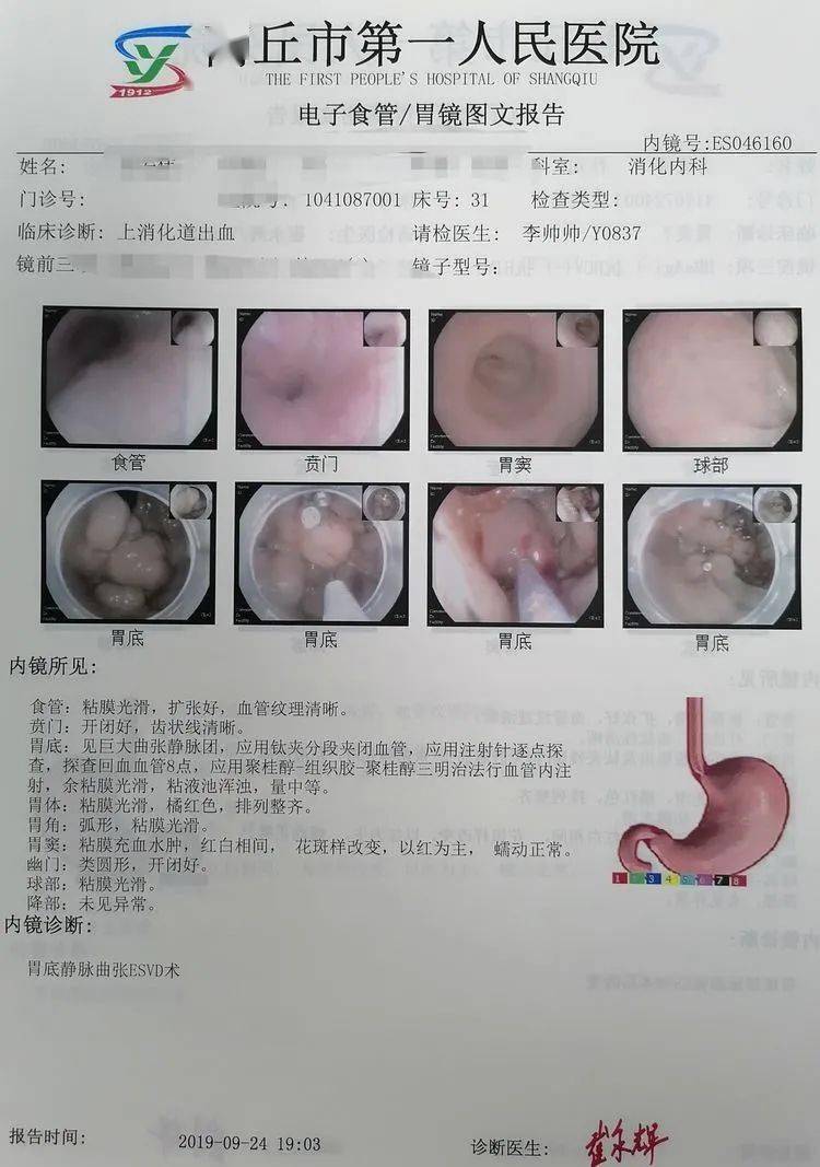 内镜下钛夹联合组织胶聚桂醇治疗胃底巨大静脉曲张1例