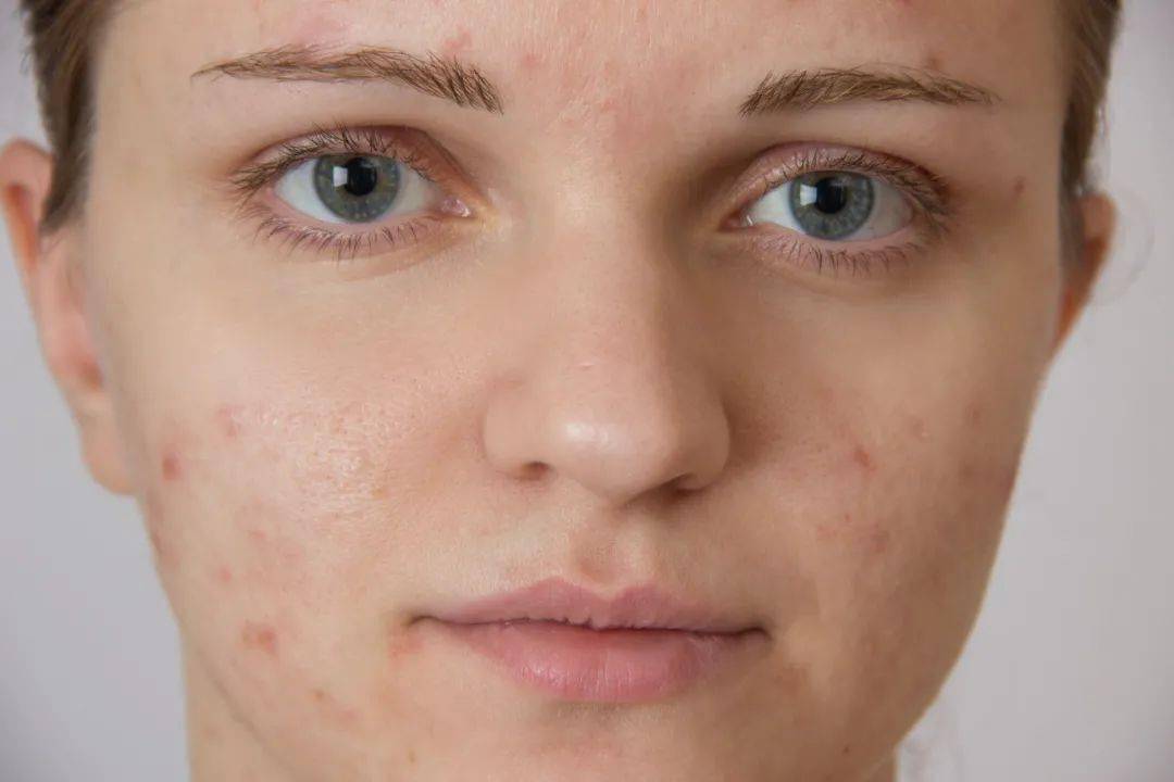 根源|三层遮瑕都遮不掉这烦人的痘印？不如就从根源下手！