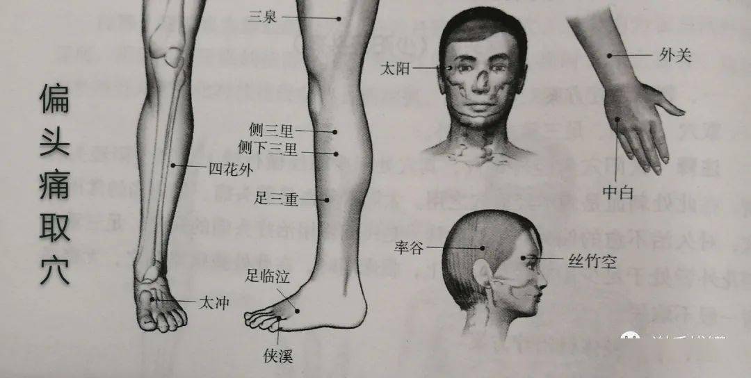 丝竹空与率谷,分别为手,足少阳经穴,二穴透刺可以行气活血,畅通少阳经