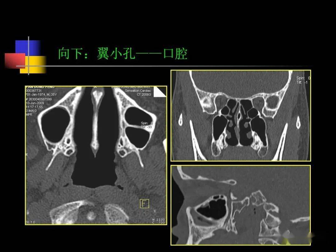 鼻咽部ct解剖