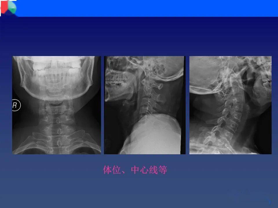 颈椎病影像再认识