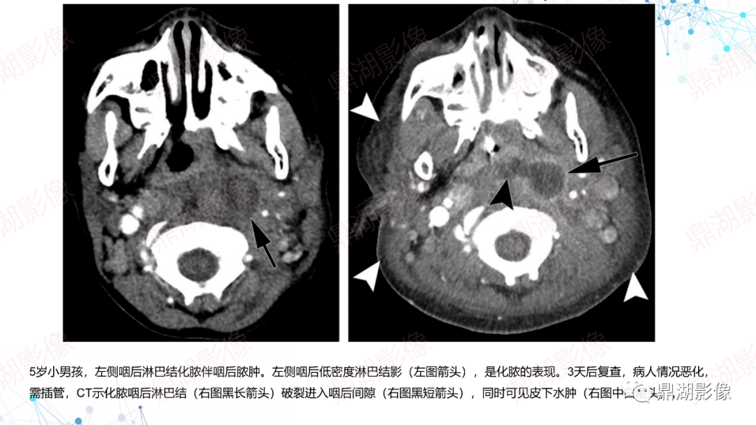 阅片的基础是解剖,颈部解剖精细繁杂,既往鼎湖发过不少关于颈部解剖