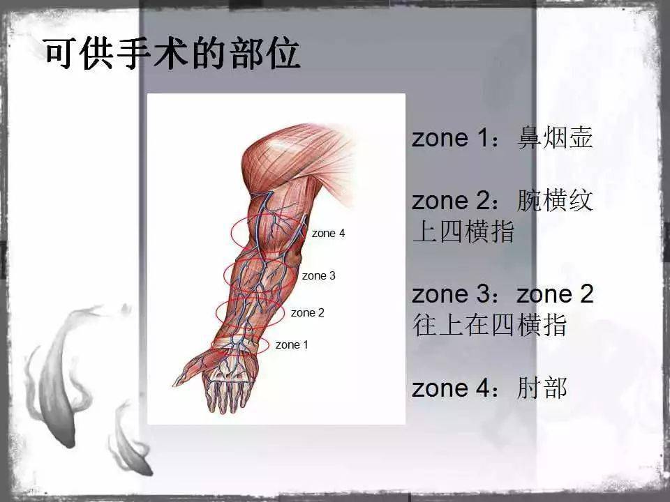 自体|血管通路 | 自体动静脉内瘘成形术