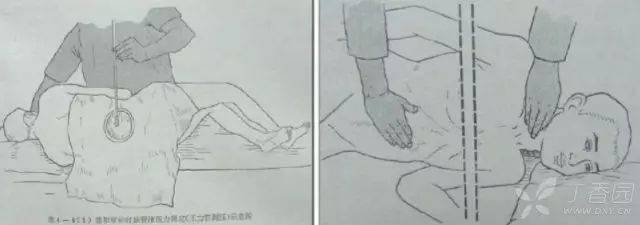 试验|腰穿测压一定要下肢伸直?腰穿检查 6 问 6 答