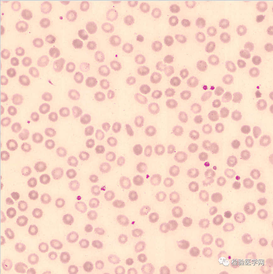 为了探寻原因,我比较了两份标本的红细胞形态(如下所示).