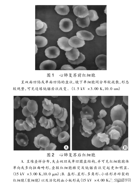 危情下的血常规神反转,99 的人都看不懂!_红细胞