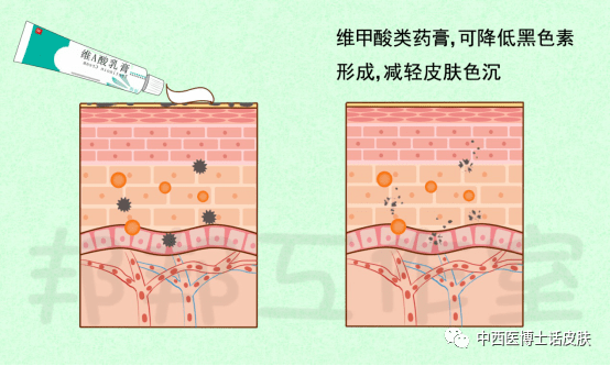 湿疹后的色素沉淀怎么办