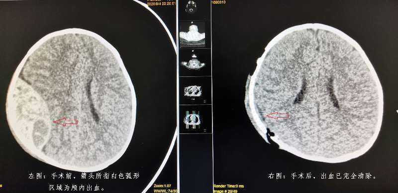 医院|珠海一8个月大婴儿坠床，送医时陷入昏迷，生命垂危