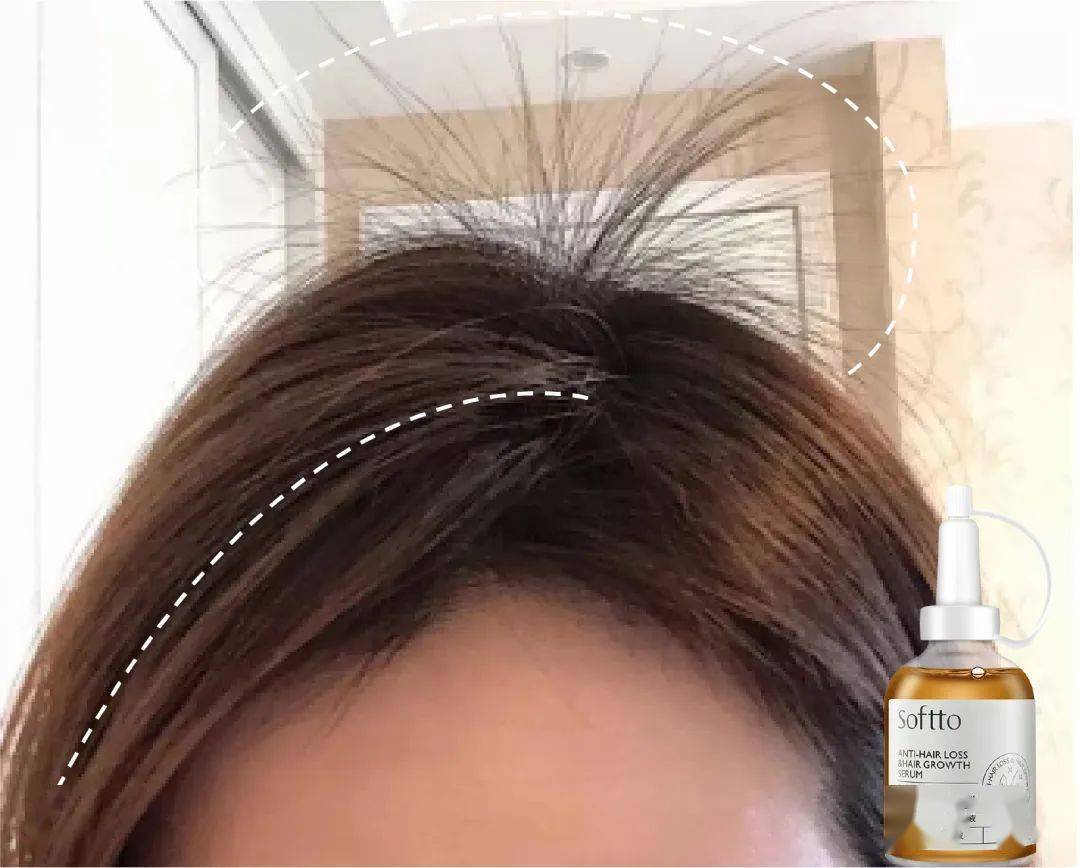 索芙特|原来发际线后移还能这样遮!我终于可以拥有“海藻头”啦