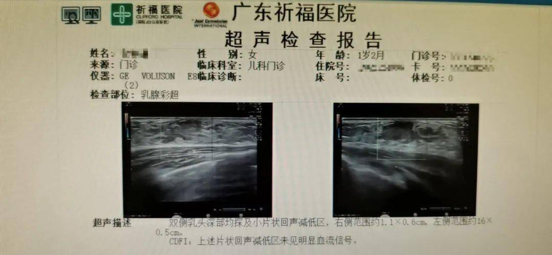 乳房|急坏妈妈!医生说…1岁女宝双乳发育隆起