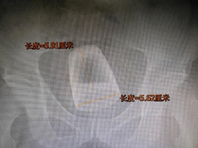 异物|【周日】罗非鱼“游”进肛门，医生在直肠里找到啤酒杯、茄子、灯泡、泥鳅.....