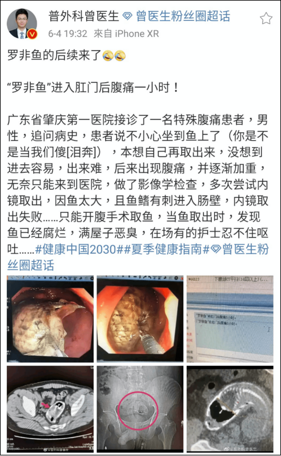 异物|【周日】罗非鱼“游”进肛门，医生在直肠里找到啤酒杯、茄子、灯泡、泥鳅.....
