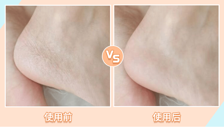 肌肤|因为粗糙的手,丢了颜值还越来越自卑,还好有它拯救了....