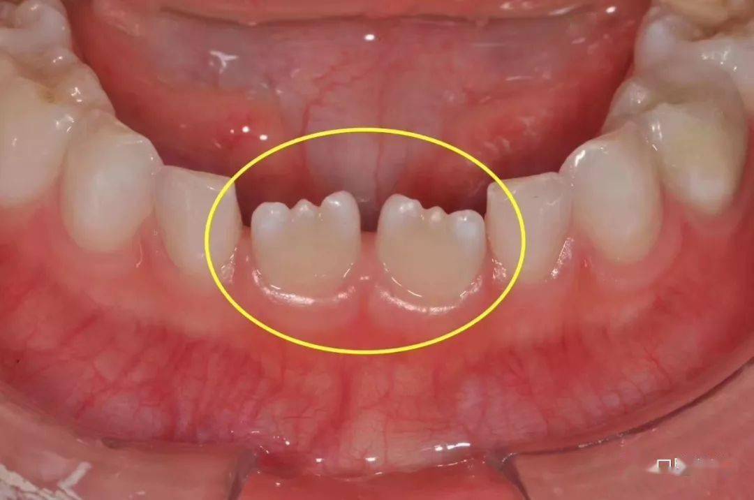 小孩牙齿为什么呈锯齿状_手机搜狐网