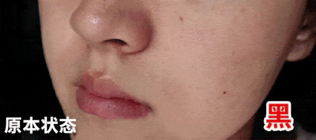 痘痘|夏天变黑长痘不可怕，赶紧用它，让你的皮肤恢复婴儿的光滑，痘痘，黑头，螨虫全都消失了