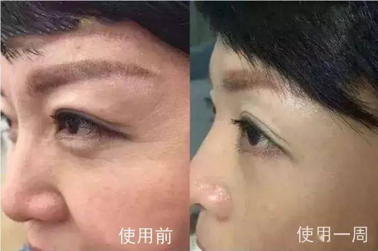 怎么去眼袋黑眼圈法令纹 9341a30dd4cf4fce8f679166736f1c06.jpeg
