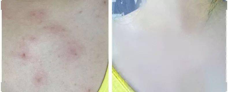 痘痘|夏天变黑长痘不可怕，赶紧用它，让你的皮肤恢复婴儿的光滑，痘痘，黑头，螨虫全都消失了