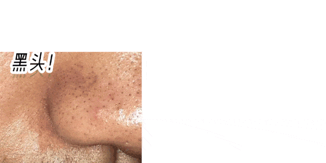 痘痘|夏天变黑长痘不可怕，赶紧用它，让你的皮肤恢复婴儿的光滑，痘痘，黑头，螨虫全都消失了