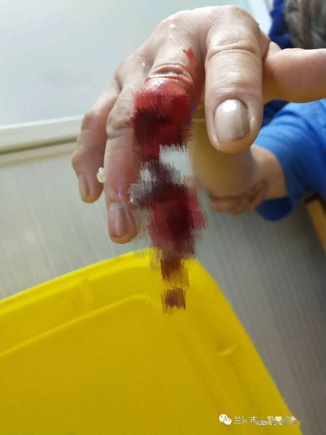 52岁阿姨意外断指,为保手指,医生竟然将手"种"进了