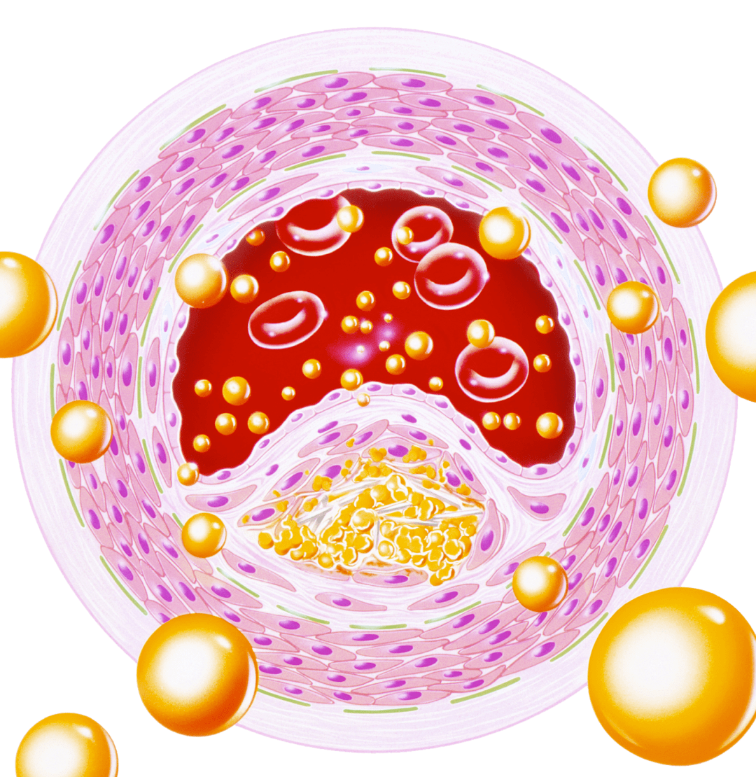 患者|高脂血症，要控制“血脂”选择什么样的食谱更有效？